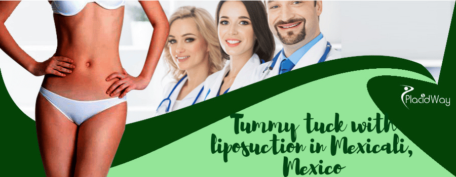 Tummy tuck with liposuction in Mexicali, Mexico